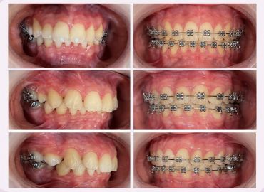 Ortodoncia y brackets